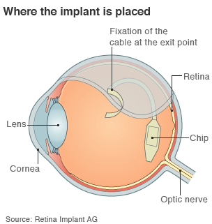 Retina Implant AG